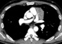 Axial contrast enhanced CT at the level of left ventricular appendage demonstrates a 6.4cm anterior lobulated mediastinal mass. The mass contains a calcification and enhances heterogeneously. One of the mass lobulations appears to indent the left ventricular appendage contour where no pericardium and no fat separates the mass from the left ventricular appendage. The CT appearance of this primary mass is aggressive suggestive of a stage III thymoma. At surgery thymoma was found with macroscopic invasion of the pericardium, consistent with stage III disease.